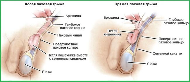 Паховая грыжа у мужчин