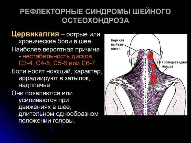Цервикокраниалгия на фоне шейного остеохондроза