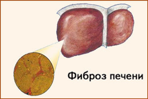 Что такоей фиброз печени и как лечить заболевание?