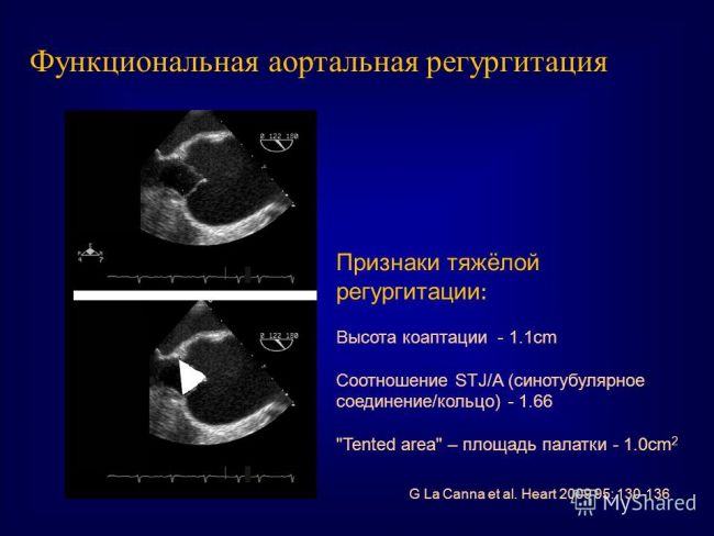 Что такое регургитация 1 степени