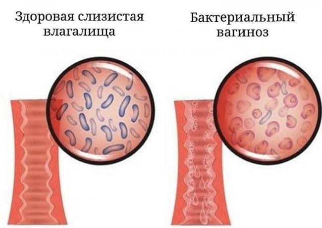 Бактериальный вагиноз: симптомы, диагностика и лечение