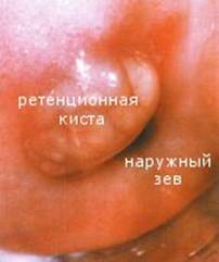Киста шейки матки: симптомы и методы лечения
