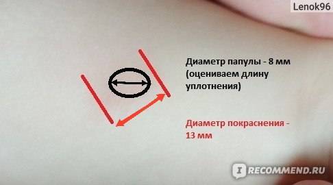 Реакция манту: норма у детей в 4 года, таблица оценки, допустимый размер пробы