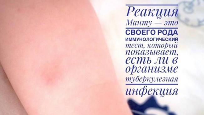 Что значит, если реакция на манту не проявилась