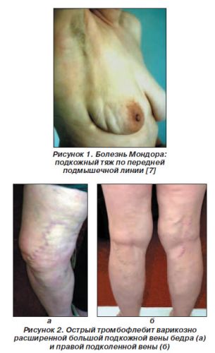 Что такое облитерирующий тромбангиит (болезнь бюргера)