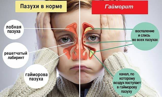 Головная боль при орви