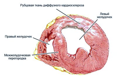 Постинфарктный кардиосклероз: причины, проявления, как избежать смерти