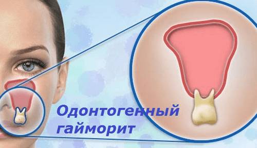 Острый верхнечелюстной синусит