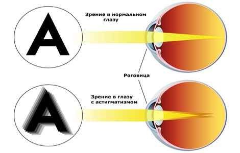 Что такое близорукий астигматизм? лечение простого и сложного близорукого астигматизма в fedorovmedcenter