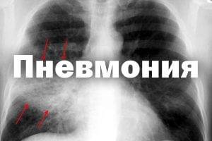 Пневмония у взрослых без температуры – как выявить болезнь?