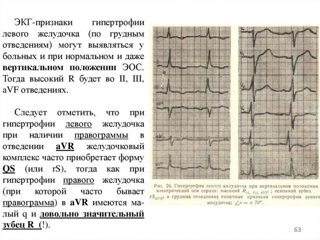 Гипертрофия правого желудочка сердца на экг. как лечить гипертрофию правого желудочка у взрослых и детей