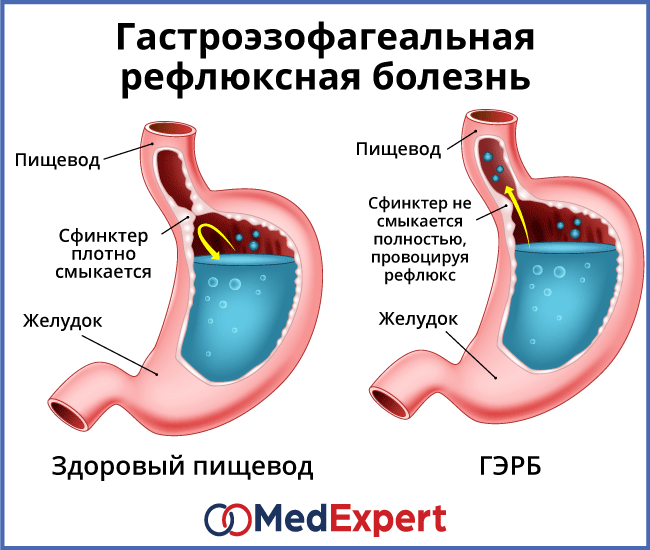 Гастроэзофагеальная рефлюксная болезнь: симптомы, лечение, диагностика