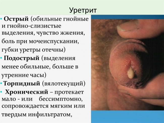 Причины выделений из уретры и их диагностика