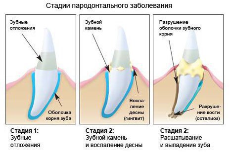 Пародонтоз и пародонтит
