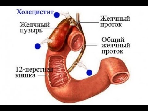 Дискинезия желчевыводящих путей - симптомы и лечение, а также причины, диета, прогноз и профилактика