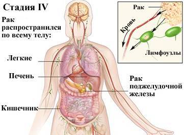 Метастазы в брюшной полости симптомы