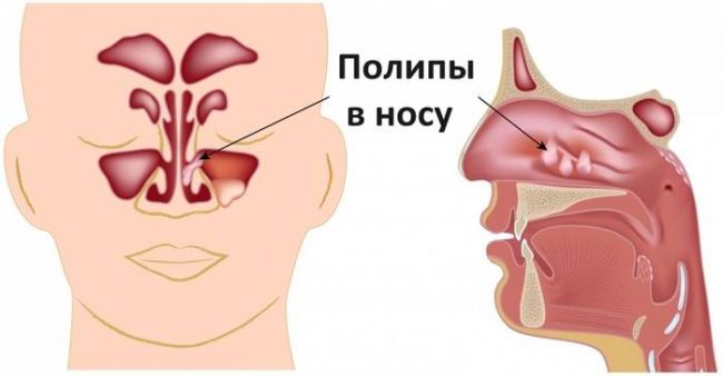 Как лечить полипы в носу — эффективное лечение народными средствами, без операций