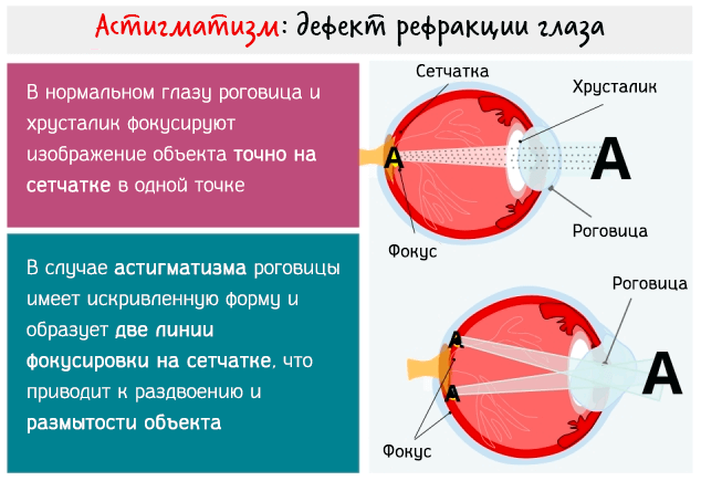 Миопия и очки тренажеры
