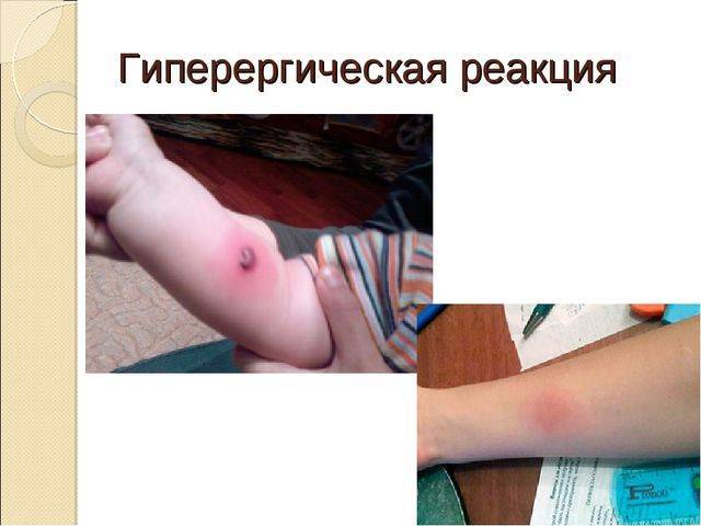 Как делают манту — все о технике проведения пробы