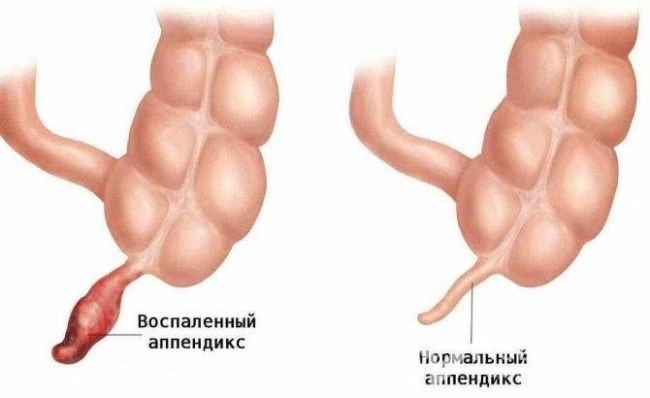 Ранний туберкулез легких у детей: признаки, симптомы, диагностика и лечение
