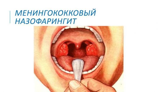 Менингококковая инфекция у детей: симптомы, профилактика, диагностика