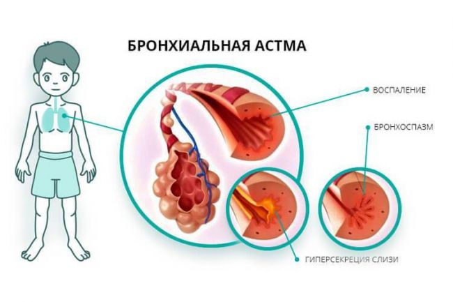 Формы и виды бронхиальной астмы: основные принципы и критерии классификации
