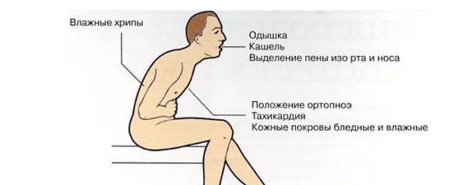 Приступ бронхиальной астмы: первая помощь
