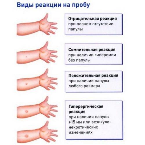 Сколько держится след от манту и когда он исчезнет