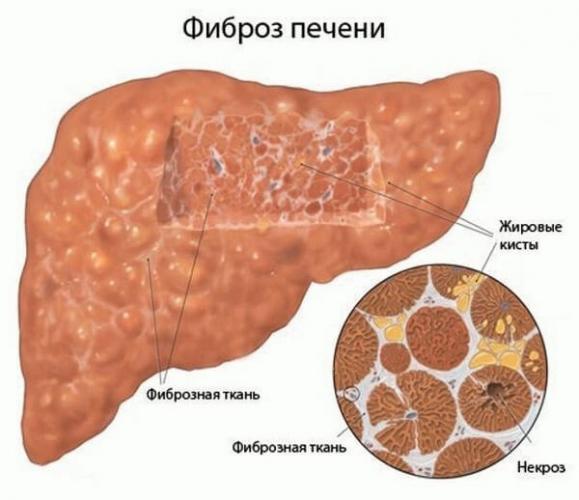 Фиброз печени 1 степени: причины, симптомы, лечение и прогноз