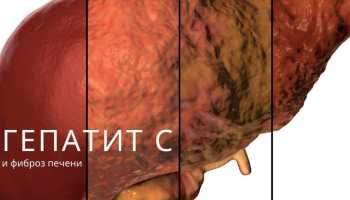 Фиброз печени: симптомы, степени, формы, причины, лечение и прогноз