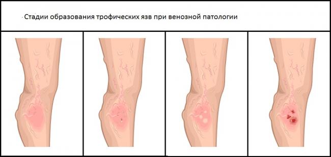 Гепатромбин гель при геморрое