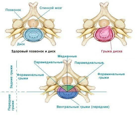 Межпозвоночная, лечение межпозвоночной грыжи, грыжа диска