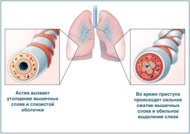 Что делать при приступе астмы: меры первой помощи