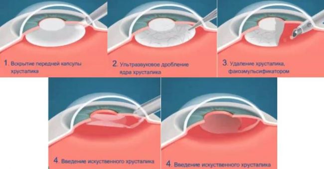 Как долго восстанавливается зрение после удаления катаракты