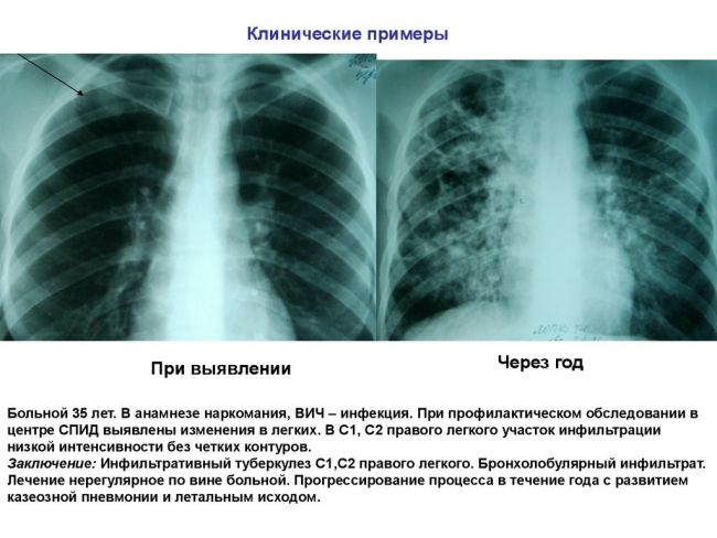 Очаговый туберкулез легких