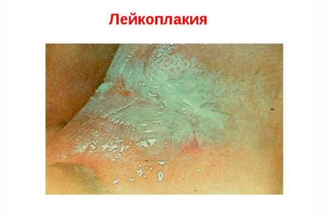 Крауроз у женщин в народной медицине