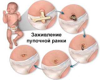 Пупок кровит у новорожденного