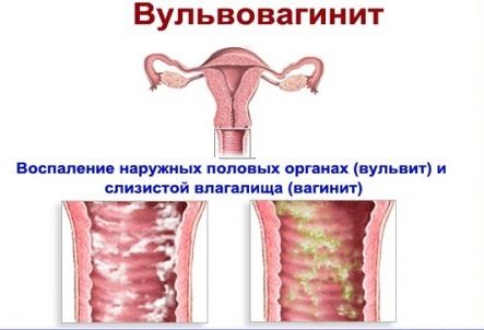 Вульвит у женщин: симптомы, лечение в домашних условиях, мази, свечи, причины