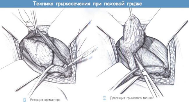 Диета после грыжи