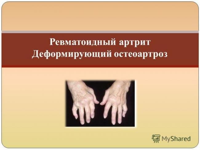 Полиостеоартроз: течение болезни и принципы лечения - нолтрекс. препарат для лечения остеоартроза, артроза, артрита, остеоартрита и других болезней суставов