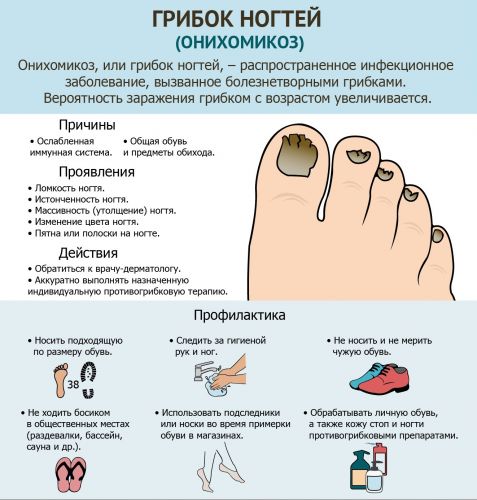 Грибок ногтей на руках