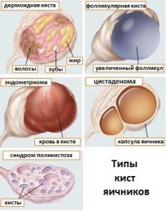 Многокамерная киста яичника: что это, причины, лечение