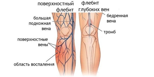 Что такое тромб, причины появления и как избежать появления тромба
