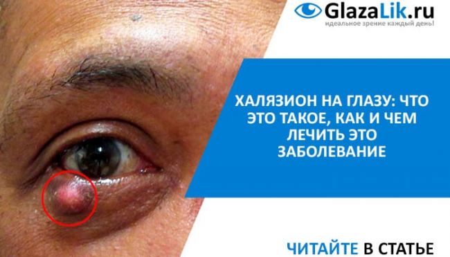 Халязион верхнего или нижнего века у ребенка и его лечение