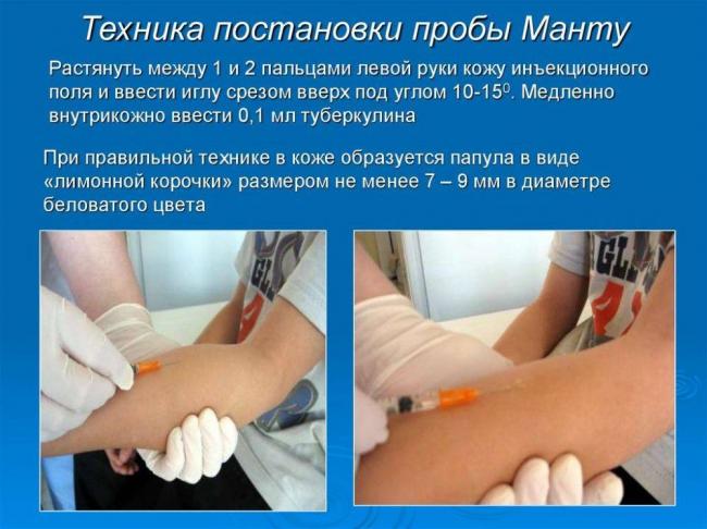 Постановка реакции манту
