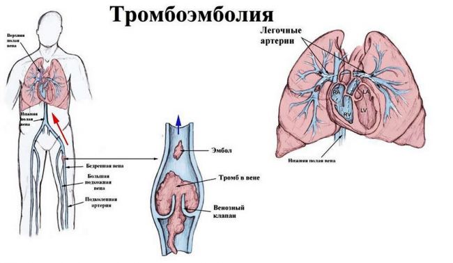 Как узнать есть ли тромбы в сосуда, от чего они образуются?