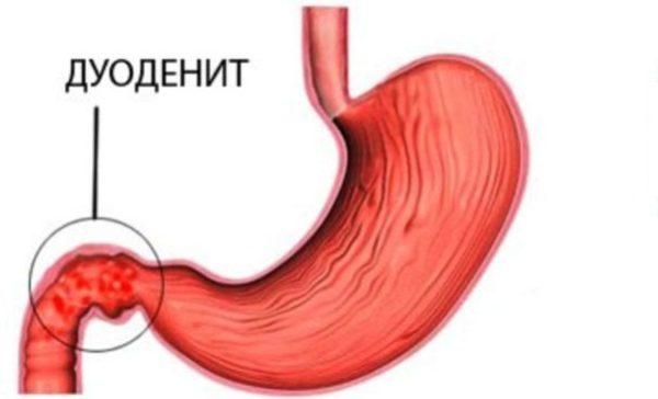 Дискинезия желчного пузыря. причины, симптомы, диагностика и лечение болезни