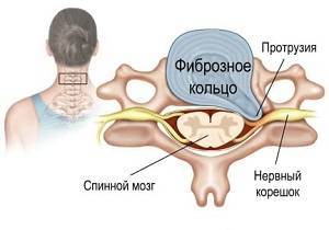 Как лечить грыжи и протрузии позвоночника?