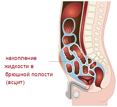 Как часто можно делать лапароцентез при асците