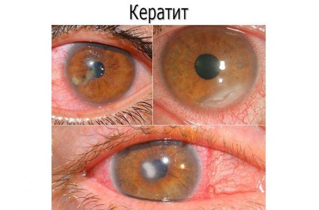 Раствор для линз контактных - состав жидкости, какой лучше